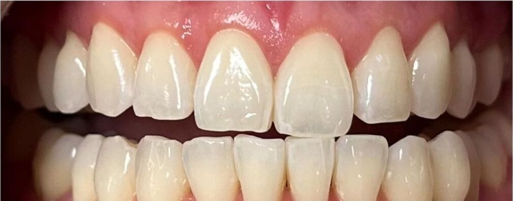 Real Retro Smile client before professional whitening at Retro Smile San Diego