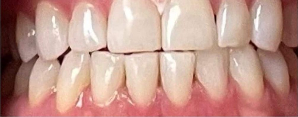 Real Retro Smile client after professional whitening at Retro Smile San Diego