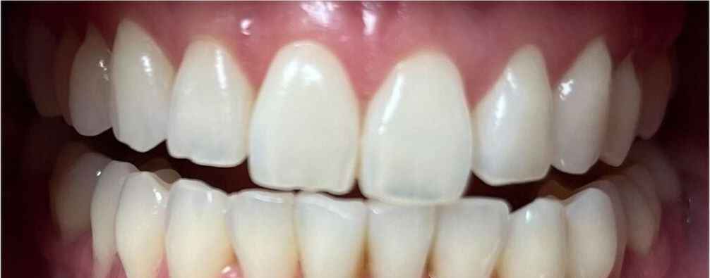 Real Retro Smile client after professional whitening at Retro Smile San Diego