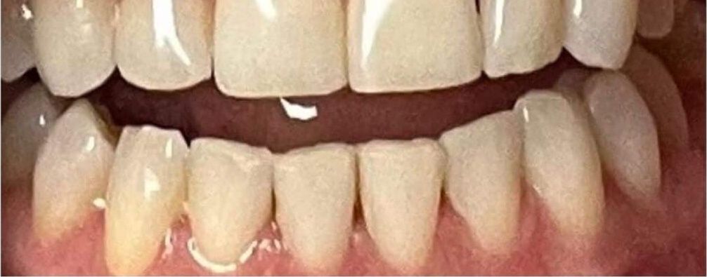 Real Retro Smile client before professional whitening at Retro Smile San Diego