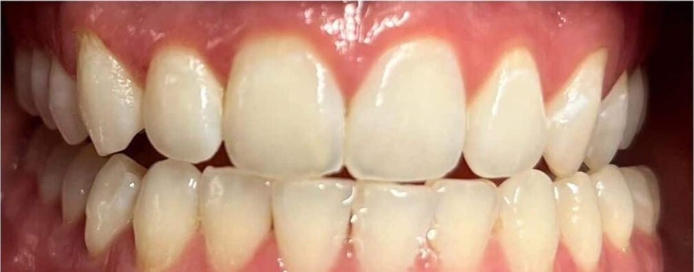 Real Retro Smile client before professional whitening at Retro Smile San Diego