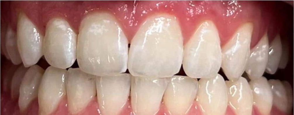 Real Retro Smile client after professional whitening at Retro Smile San Diego